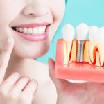 Имплантация зубов: современные технологии восстановления утраченных зубов