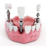 Имплантация зубов: современные технологии в стоматологии